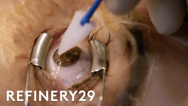 'What Getting Laser Eye Surgery Is Really Like | Macro Beauty | Refinery29'